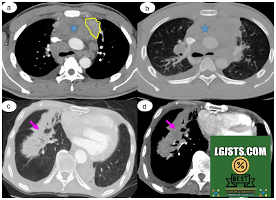 CT analysis of pulmonary lymphoma