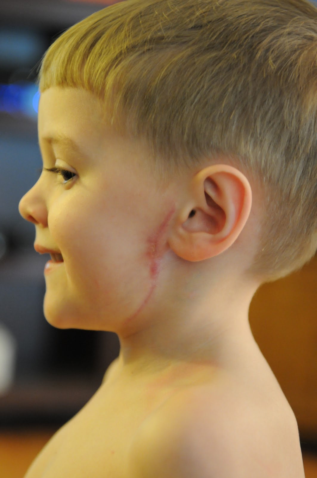 laryngomalacia-tracheomalacia-bronchomalacia