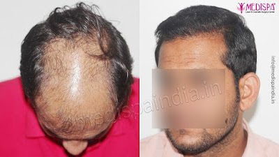 Hair transplant in Gurgaon