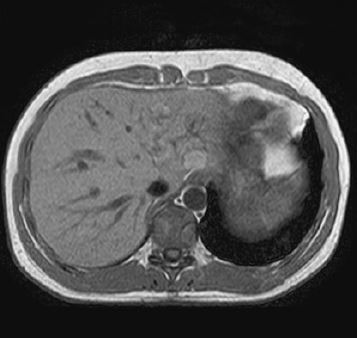 Liver MRI – and RadTechOnDuty