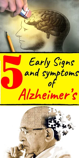 5 symptoms of Alzheimer’s