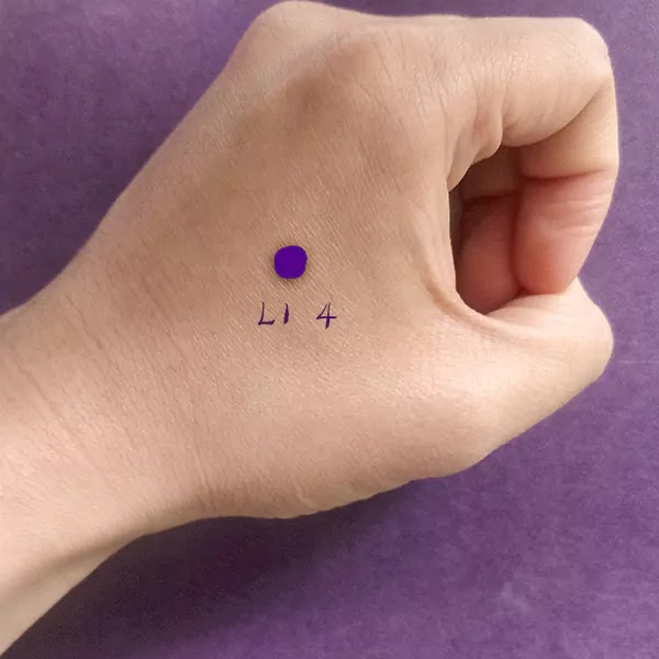 Acupuncture for Migraines