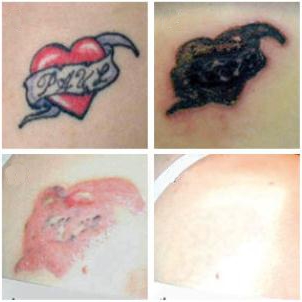 ... Tattoo Removal Before and After Pictures | Tattoo Removal Methods