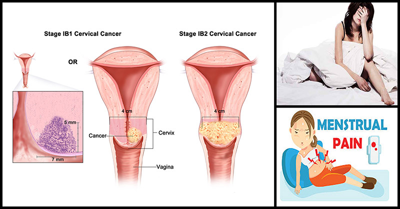 Signs of cancer warning cervical Cervical Cancer