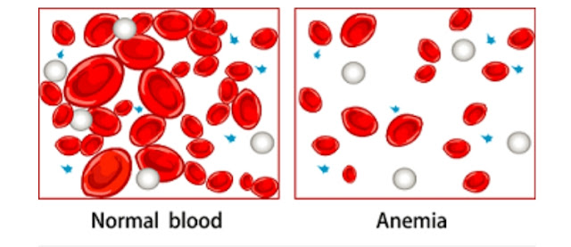 What is anemia? | Anemia's Symptoms | Symptoms of Anemia in Women