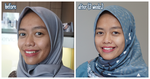 Hasil Treatment Single Active Acne Therapy by IPL di Erha Skin Setiabudi