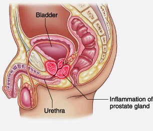 bacterial prostatitis wiki)