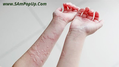 Indian Home Remedy For Skin Allergy | स्किन एलर्जी के घरेलू उपचार
