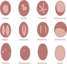 Hymen types represented via many pics in a pic chart