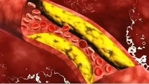 what causes plaque in the arteries what causes plaque in the arteries