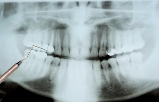 radiografia dentária