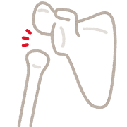 肩関節脱臼のイラスト