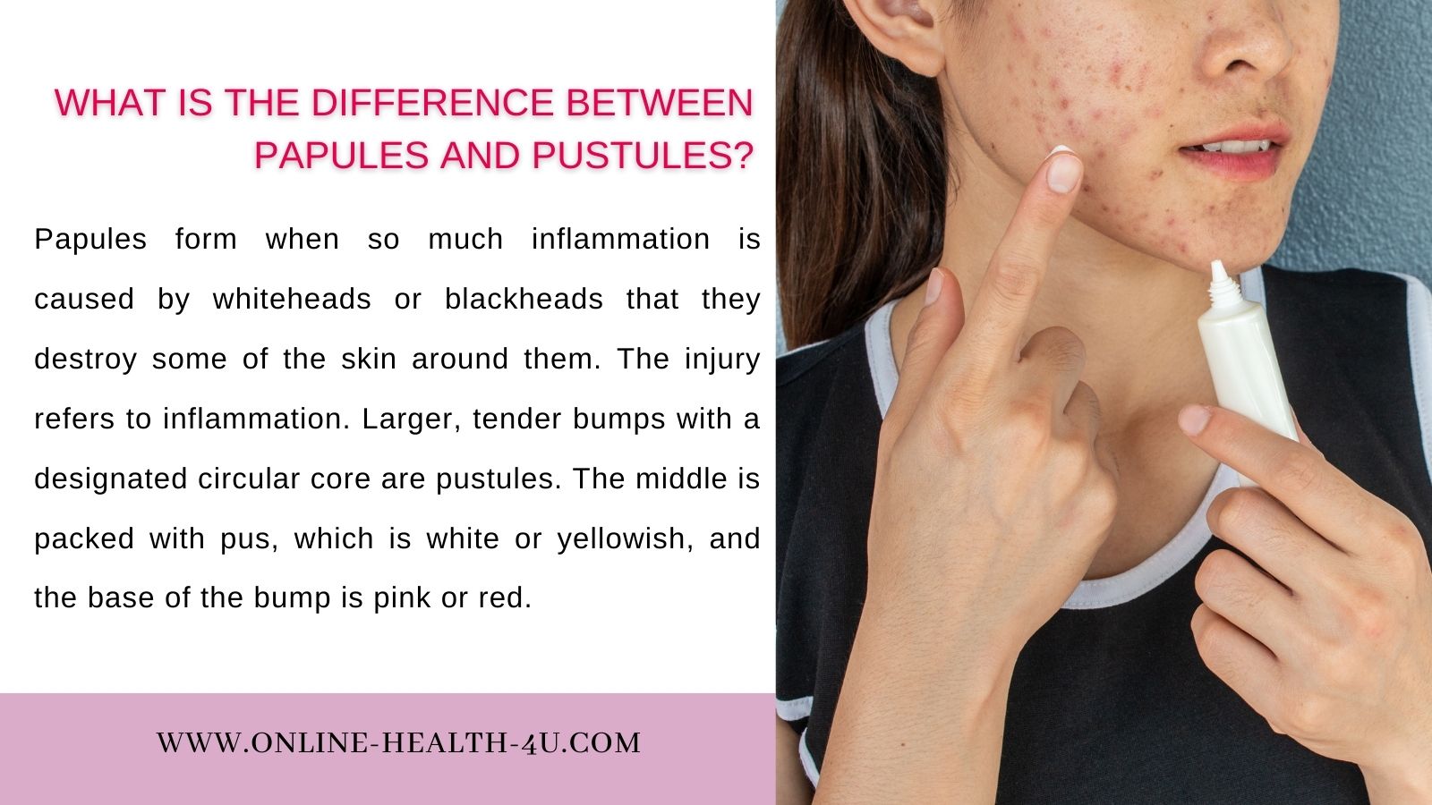 papules-pustules-causes-symptoms-treatment