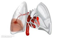 Embolia pulmonar (EP ) es una enfermedad muy común y altamente letal que es la principal causa de muerte en todos los grupos de edad.