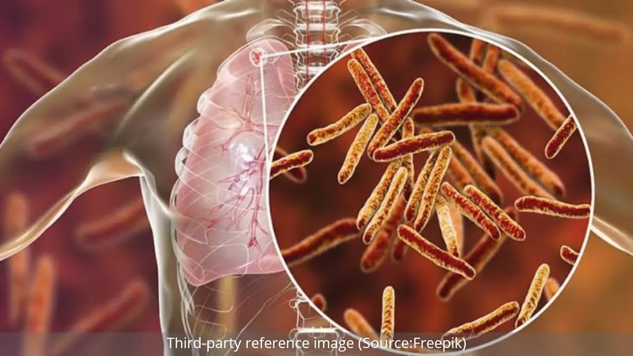 Tuberculosis : Symptoms, Causes and Treatment | HealthInsta Tuberculosis : Symptoms, Causes and Treatment | HealthInsta