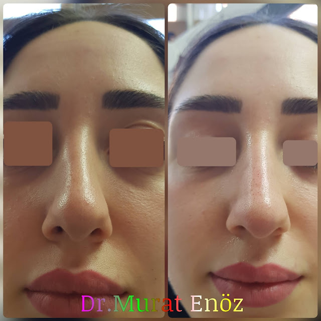 Non-surgical rhinoplasty in Istanbul - The 5 Minute Nose Job in İstanbul - Non-surgical nose job - Nose filler injection Turkey - Injectable nose job - Liquid rhinoplasty