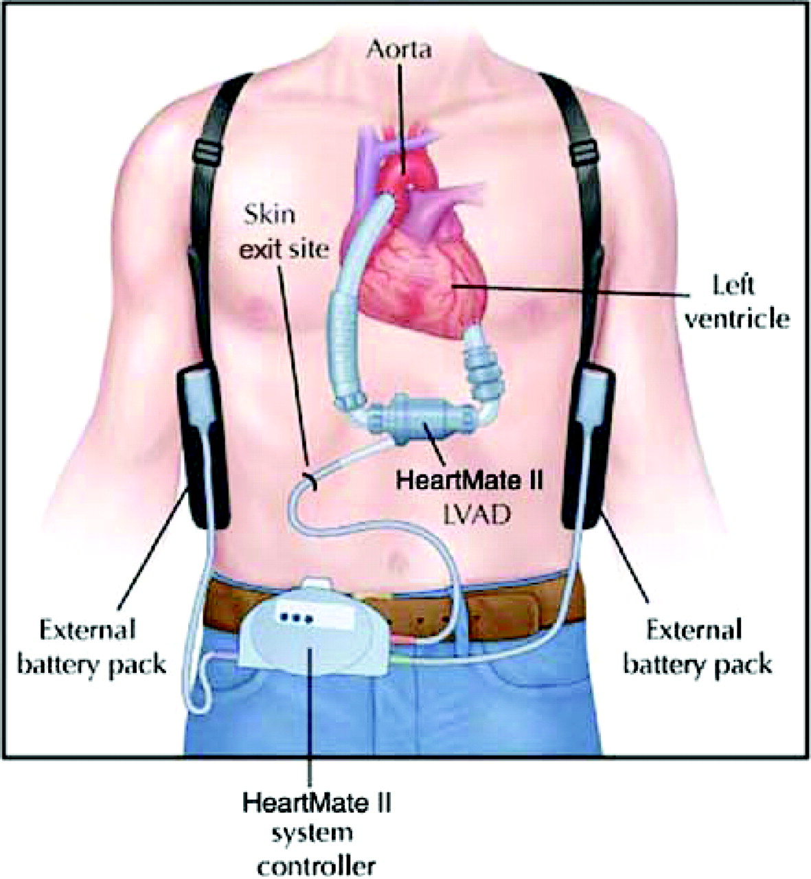 Left Ventricular Assist Device (LVAD) How Does It Work? Left Ventricular Assist Device (LVAD) How Does It Work?