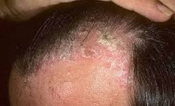 obat gatal di kulit kepala