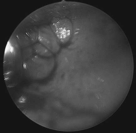 Hysteroscopic Complications