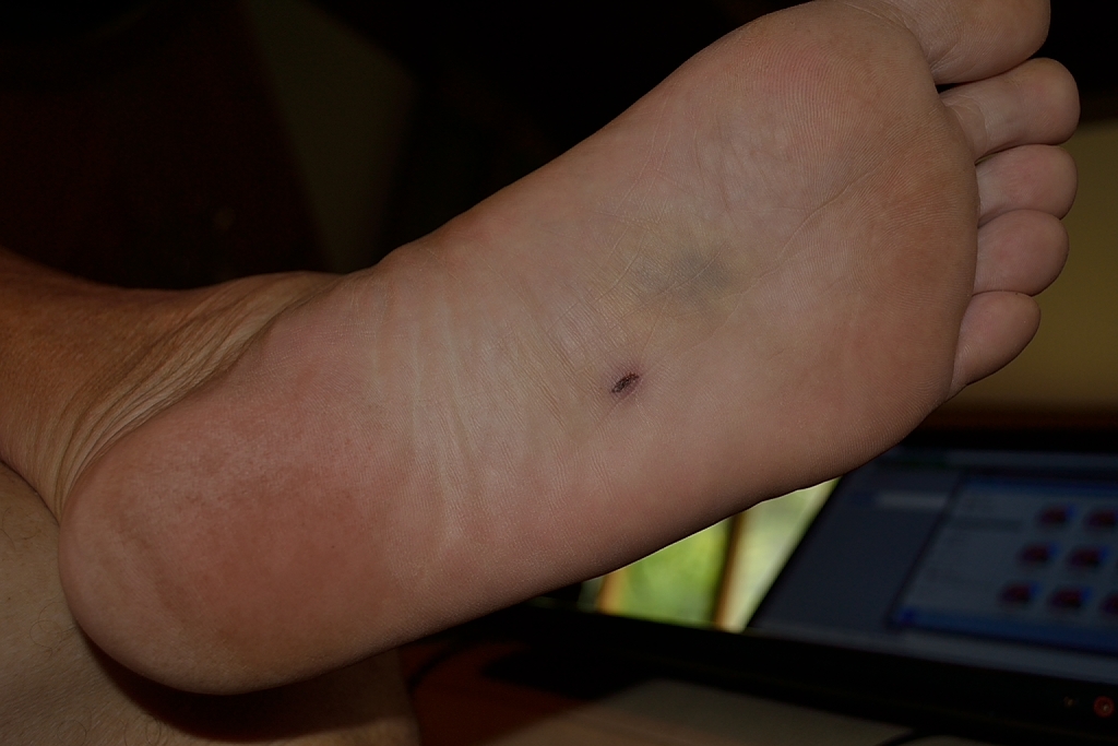 Blood Treatment For Cancer Foot Puncture Wound Treatment