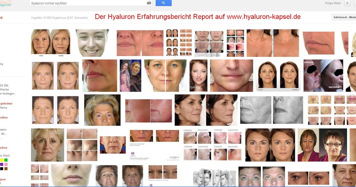 Hyaluron Kapseln Wundermittel Hyaluronsaure Im Test Fur Haut Und Gelenke Erfahrungen Mit Hyaluron Kapseln Vorher Nacher
