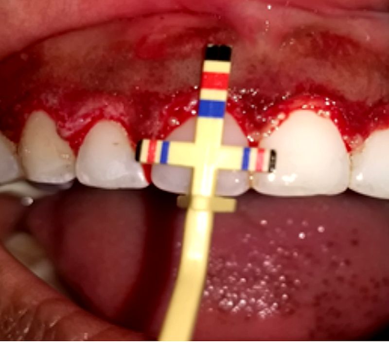 PDF Gingival Hyperplasia a Sequalae of Orthodontic Therapy A case report