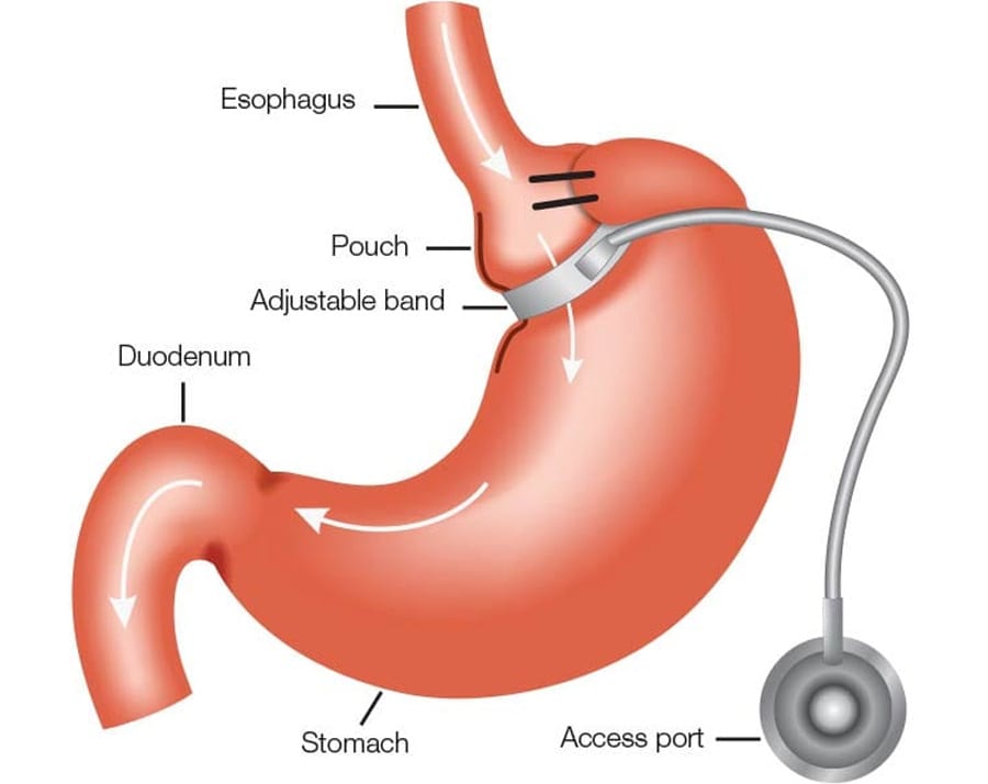 Best 4 Weight Loss Surgery: Which can help you lose extra weight Laparoscopic adjustable gastric banding