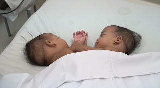 Proses 9 Jam Lebih, Operasi Pemisahan Bayi Kembar Siam Berhasil