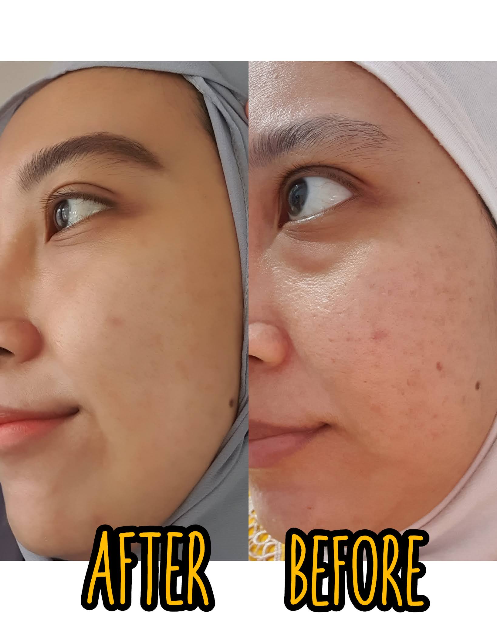 Pengalaman melakukan perawatan wajah bebas jerawat di ERHA Ultimate