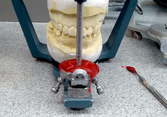 OCCLUSION: Custom Incisal Guide Table, Fabrication (Video 2)