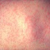 Ιατρικός Σύλλογος Πρέβεζας:Λοίμωξη από τον ιό της ιλαράς 