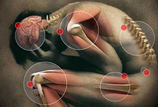 Figura humana en posición fetal con zonas dolorosas marcadas por puntos rojos