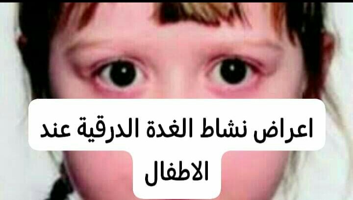 أعراض وعلامات نشاط الغدة الدرقية