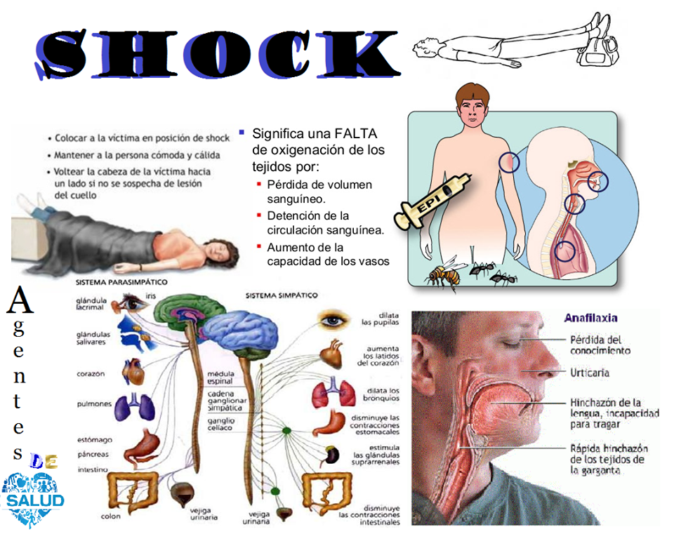Agentes de Salud Shock (Choque) Agentes de Salud Shock (Choque)