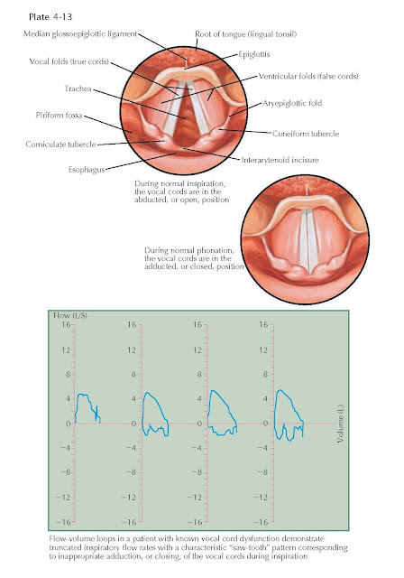 VOCAL CORD DYSFUNCTION