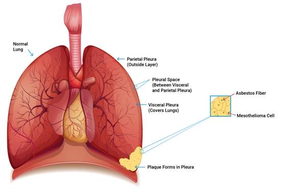 what is mesothelioma and how it develops