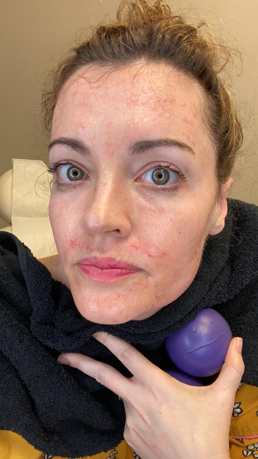 PRP Vampire Facial, Before and After...with a Video of what it was like! Stained with Style