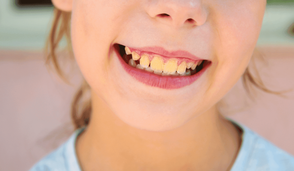 Tooth Discoloration Causes: How to Avoid Teeth Staining?