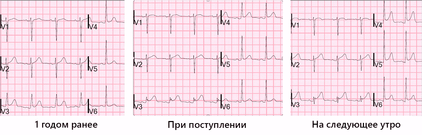 Диффузное нарушение процесса реполяризации сердца. СРРЖ на ЭКГ. ЭКГ при синдроме ранней реполяризации. Синдром ранней реполяризации на ЭКГ. Ранняя реполяризация желудочков на ЭКГ.