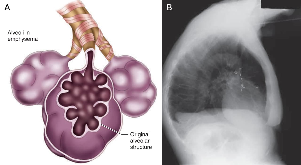 Medical Terms & Сlinical Сases Emphysema