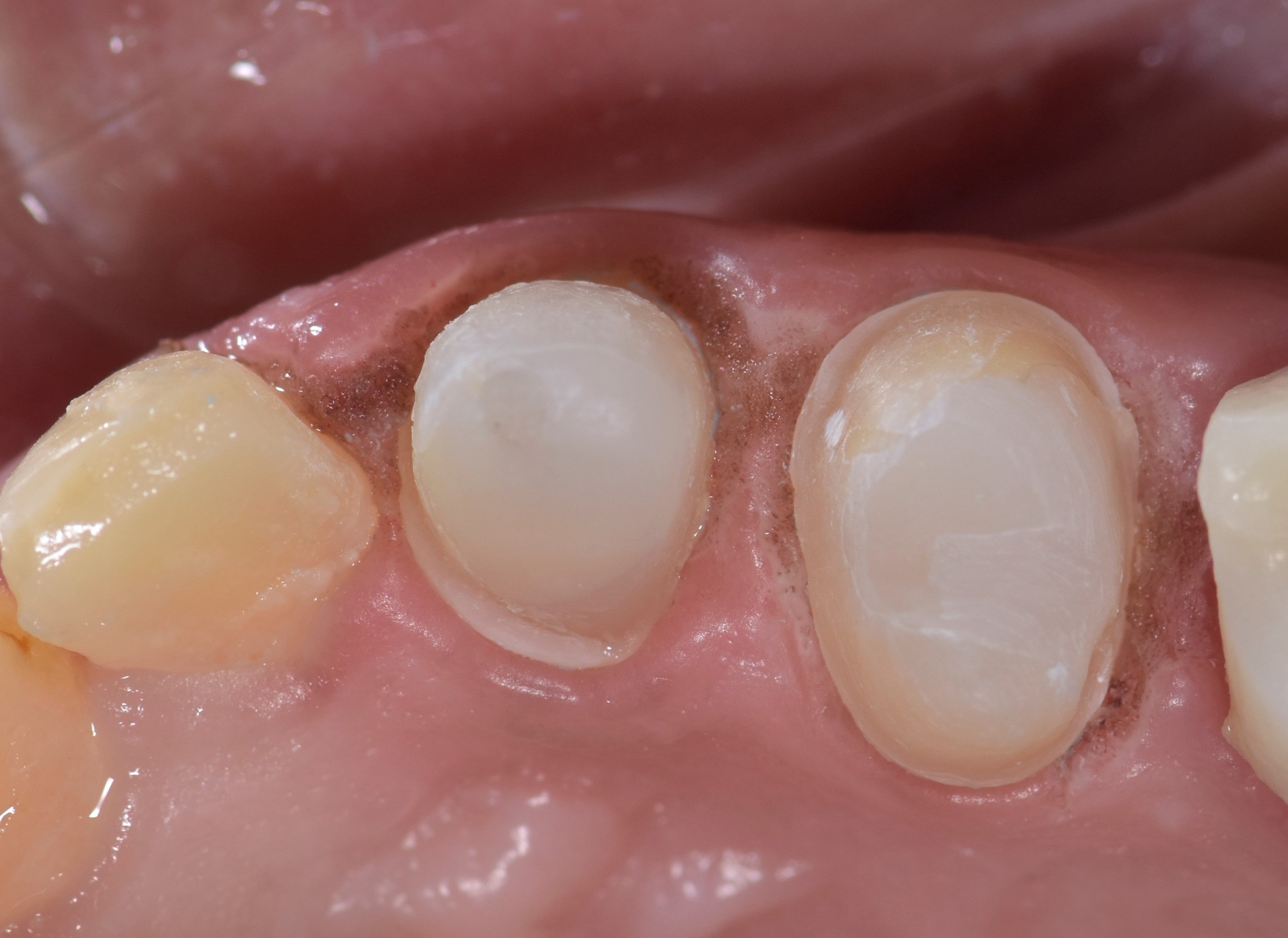 Retraction cords.. Why? When? How? Dental Esthetics