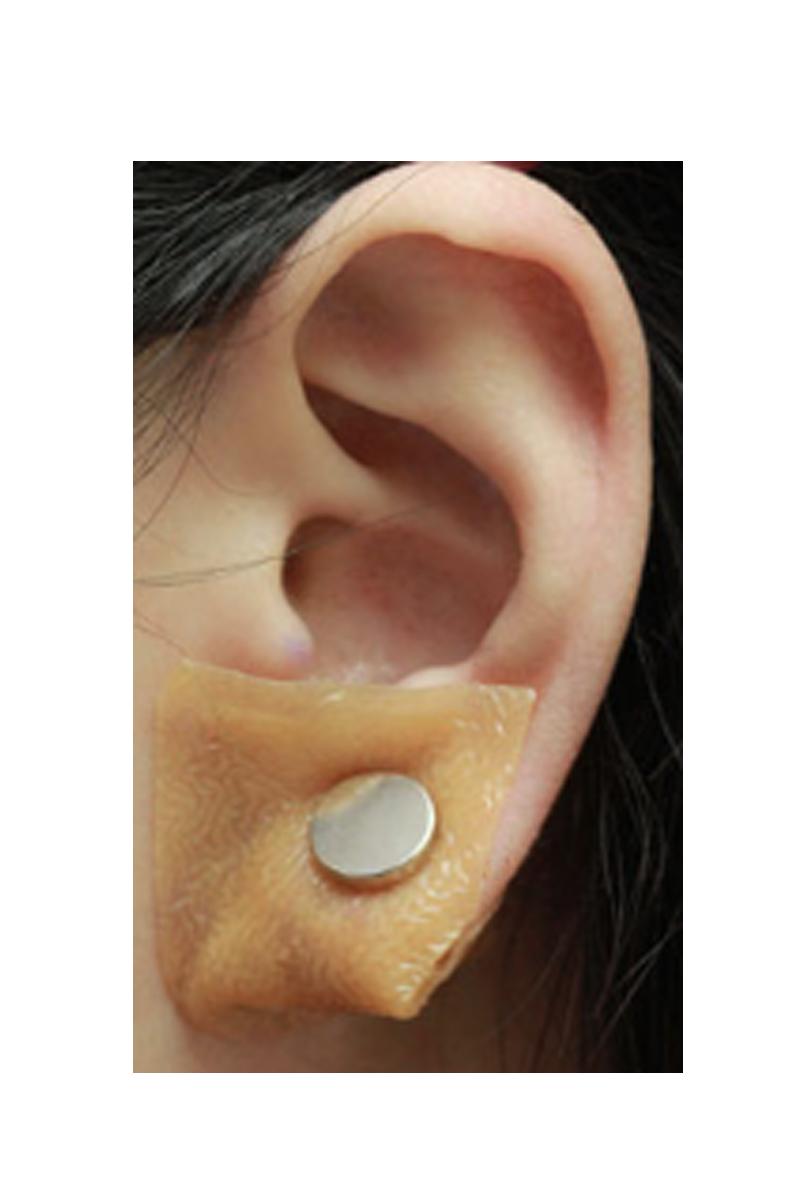 EARLUMS BLOG Preventing the recurrence of earlobe keloids after surgical removal, a reliable