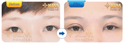 Hình ảnh khách hàng khi thực hiện cắt mắt 2 mí tại KIM Hospital.