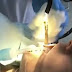 VÍDEO: Mulher passa por cirurgia para retirar cobra da garganta: 'entrou enquanto ela dormia'