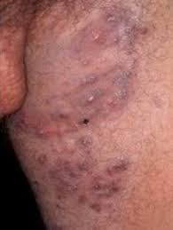 obat gatal selangkangan dan alat vital sudah hitam