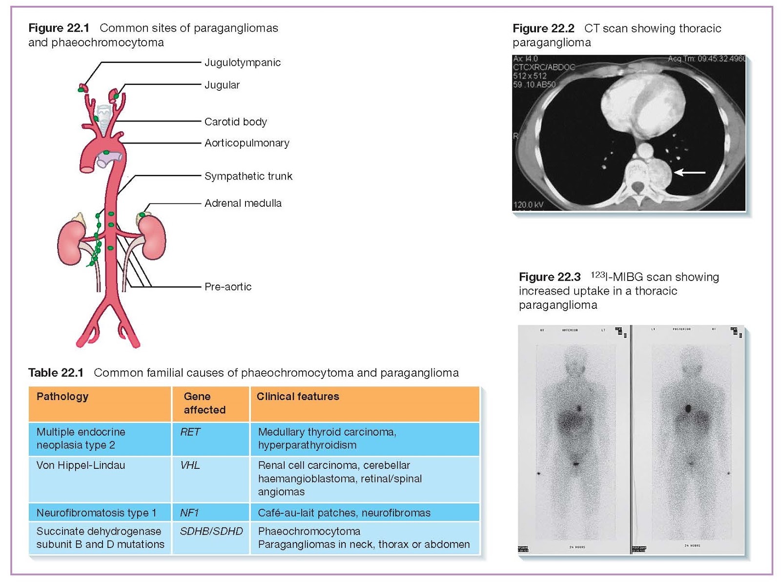 Disorders Of The Adrenal Medulla pediagenosis