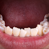 Giai đoạn nào niềng răng đau nhất?