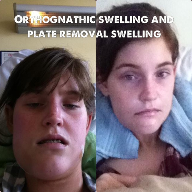 A Guide to Surviving Orthognathic Surgery Recovery from Plate & Screw