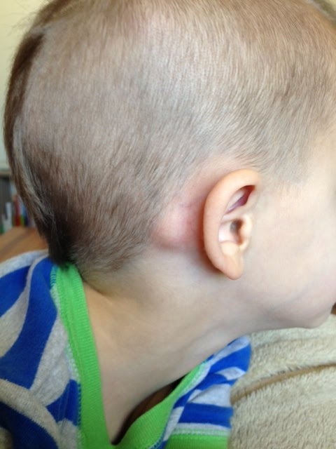 Movable Lump On Back Of Babys Head Dikiblogging