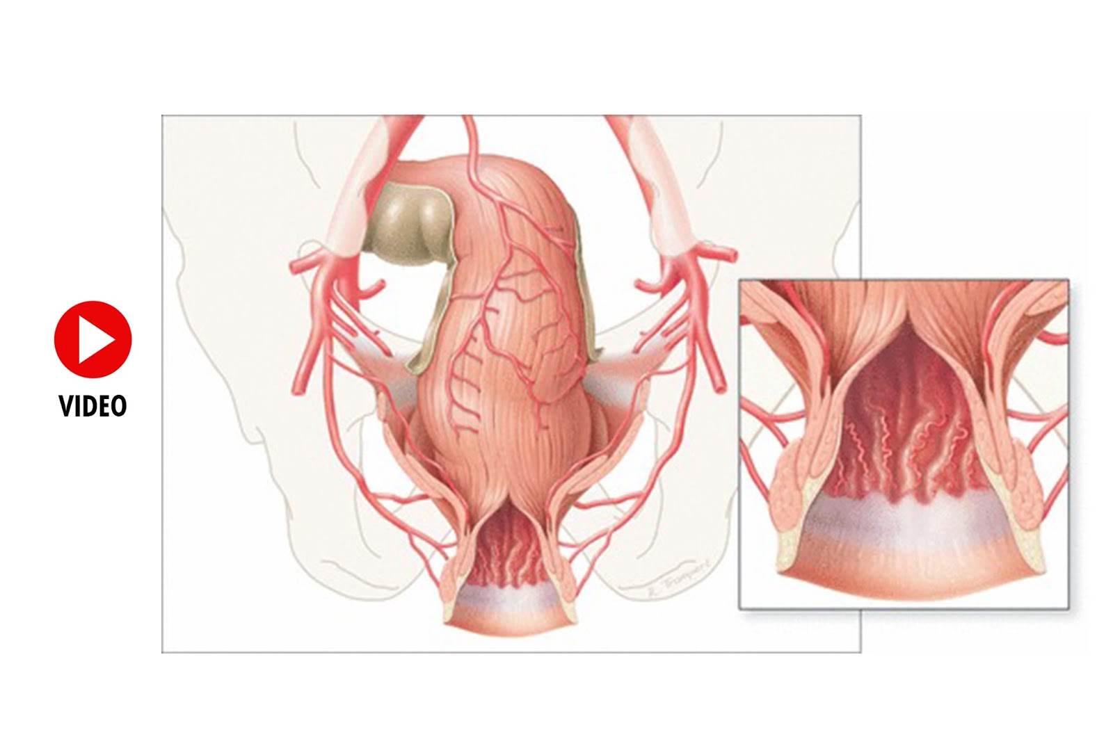 Mengobati Wasir Internal